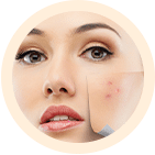 Acne Clearing Facial